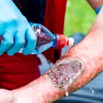 medical worker treating burns male039s hand